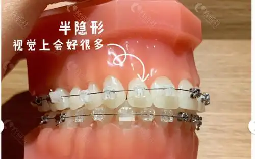 深圳2021新版牙齿矫正收费价目表公开,整牙费用看这个就够