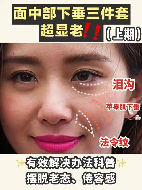 苹果肌下垂6315衰老三件套结合解决摆脱倦容_苹果肌_成都远洋