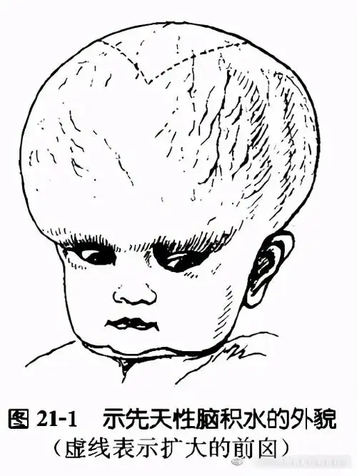 落日目现象透光实验脑积水磁共振表现什么是脑积水小儿脑积水是一类