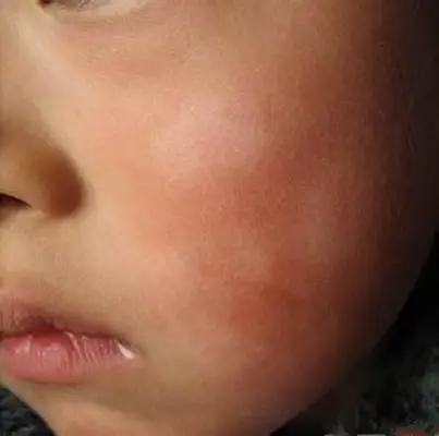 单纯糠疹 (37)_有来医生