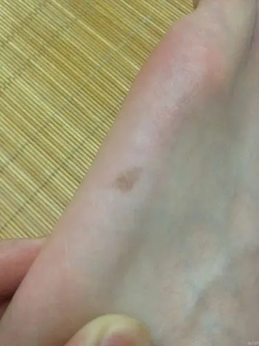 左脚脚掌侧面的一颗痣,是否需要切除,有无隐患