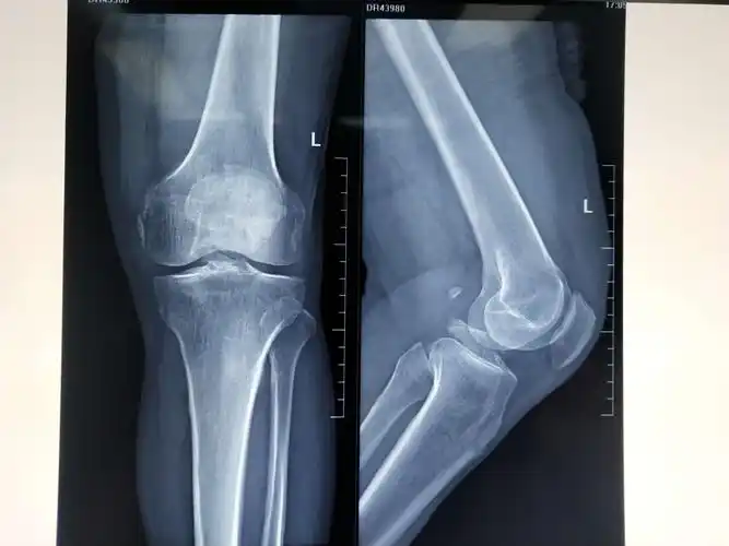 关节镜下单骨道单对纽扣钢板固定治疗大块胫骨髁间嵴骨折