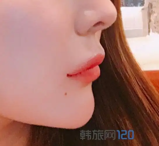 如果嘴唇太薄或太厚,一般不建议直接做笑唇