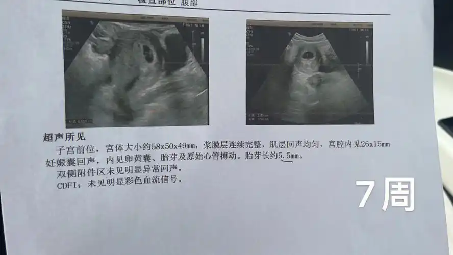 小孕囊问题有没有一样的姐妹