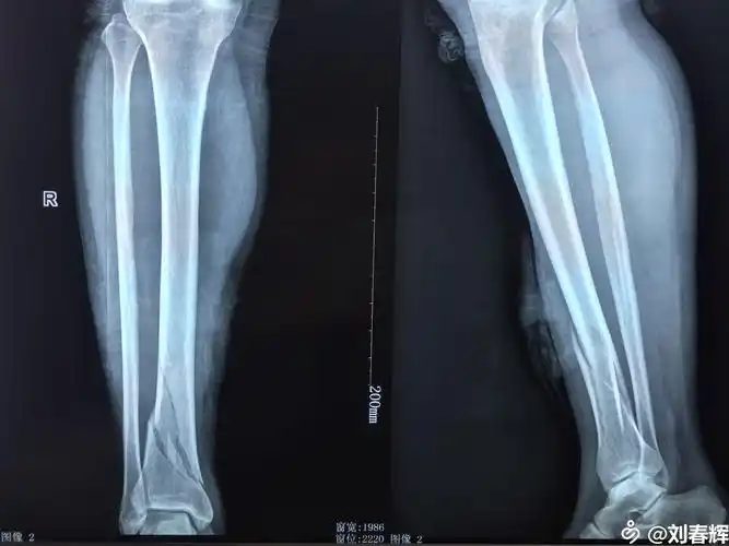 右胫骨开放性骨折