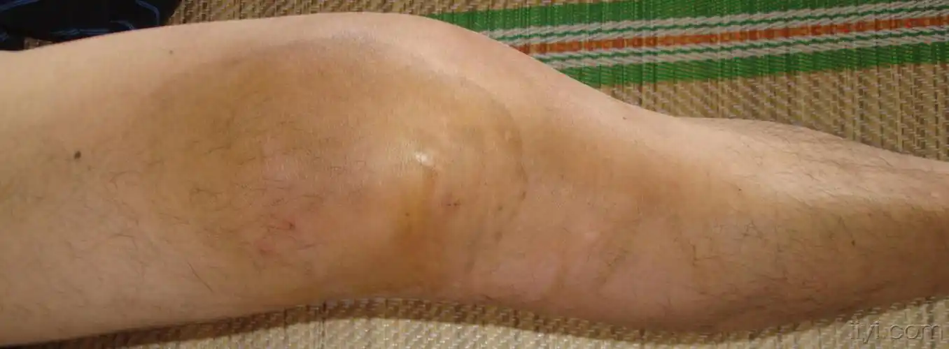 病例讨论化脓性关节炎一例