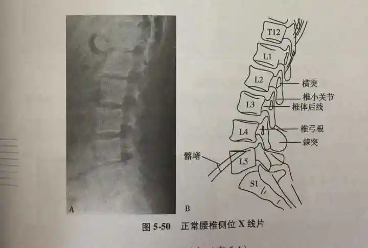 这是正常的腰椎侧位x-ray,患者的腰椎侧位片显示, 腰椎生理曲度的