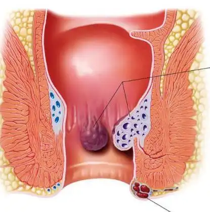 在校大学生是怎么消除自己鸡蛋大的痔疮外痔肉球的你学会了吗