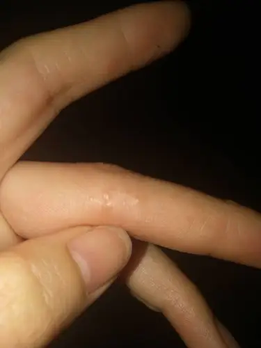 2条回答  夏天血热就这样,我以前也总出现这种小疙瘩,像小水泡似的.