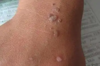 1女人感染hpⅴ有啥症状图片