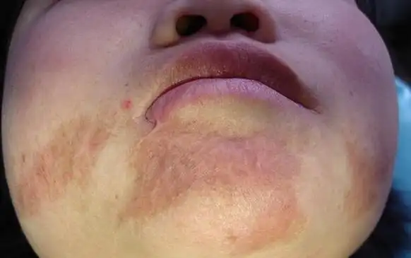 烧伤疤痕15年烧伤疤痕20年头皮烧伤后疤痕性脱发更多烧伤图集敬请期待