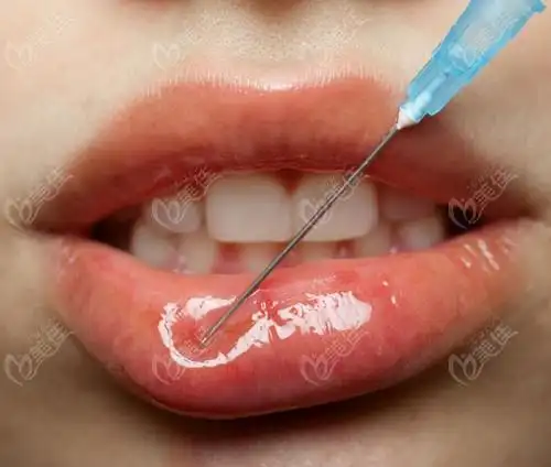 去南宁做嘴唇整形医院咨询上嘴唇改薄多少钱价格你肯定想不到