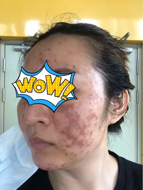 在该医院坐果酸换肤美白项目被毁容脸部皮肤大面积被烧伤