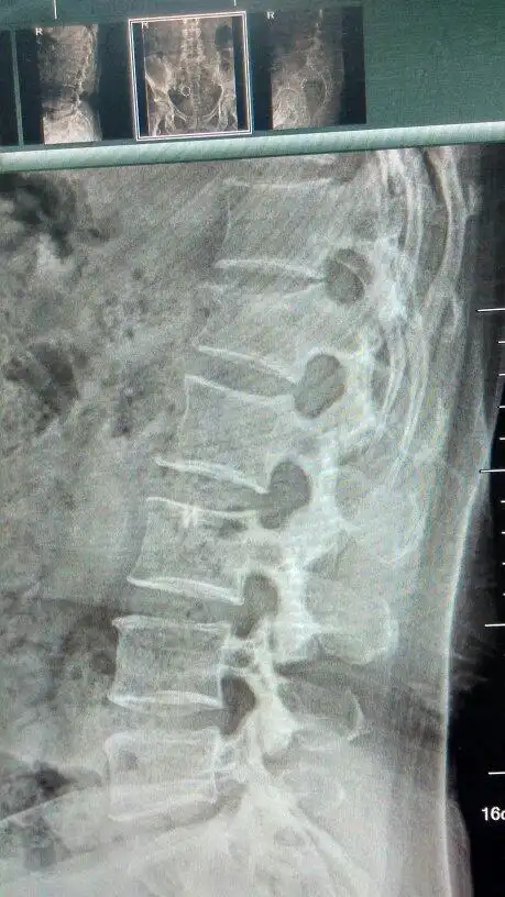 腰椎压缩性骨折(椎1)三分之一,吃三七粉是否有助于恢复?