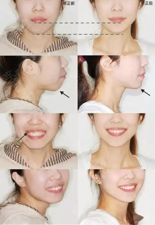 嘴突 下巴缩 露龈笑,牙齿矫正比你想_圈子-新氧美容整形