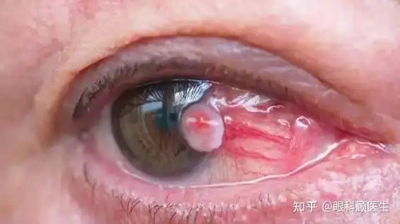 眼睛里的"息肉"到底是什么?