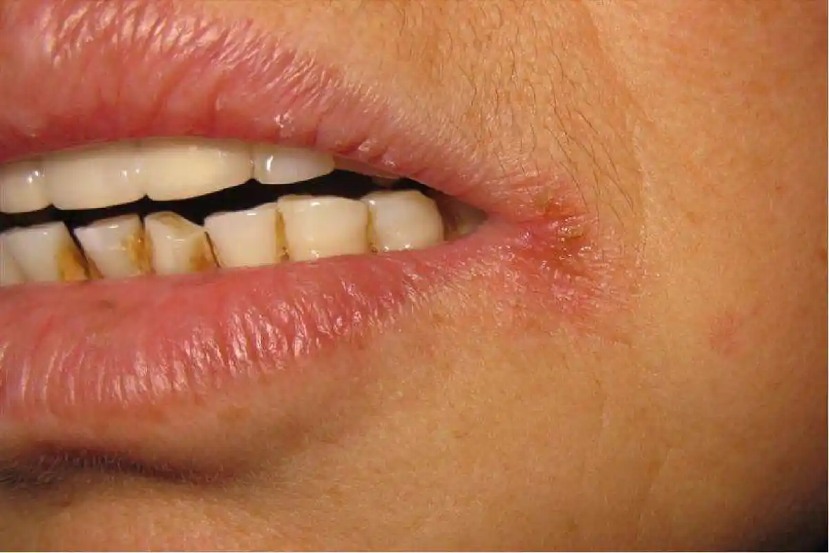 嘴角长马嚼子疮图片