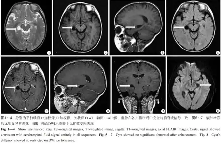 脉络膜裂囊肿影像表现