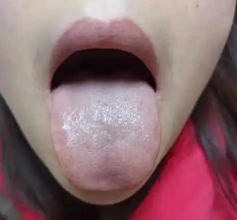 从舌头看健康,中医舌诊案例分析:拍下你的舌象,沈大夫帮你辩证 - 知乎
