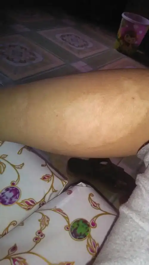 6 2012-12-15 腿上有疤痕参军体检能过吗 9 2008-11-24 腿上有个长20