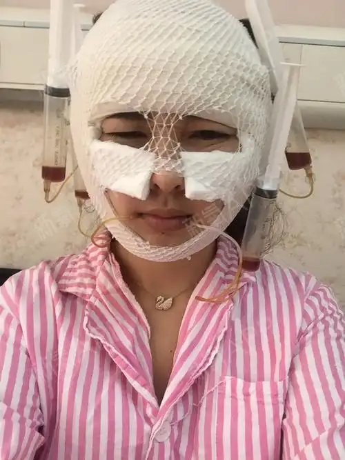 全脸包着厚厚的纱布,整个头都_圈子-新氧美容整形