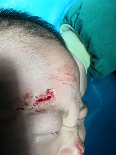 男性患者做梦时不慎从床上摔下来,我为患者做眼睑裂伤清创缝合手术术