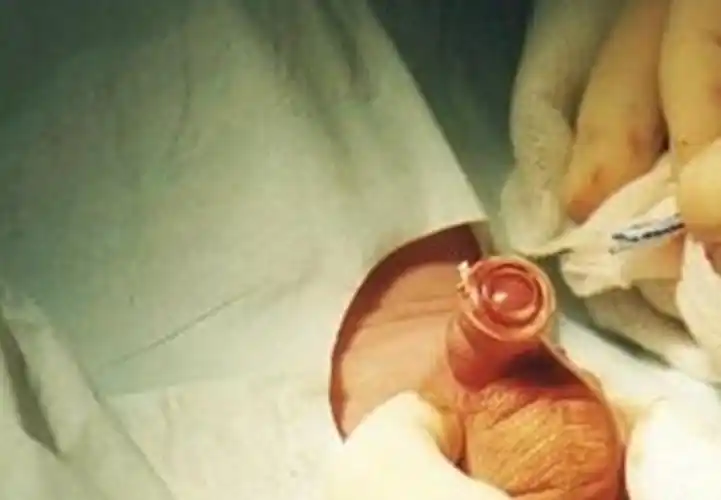 男孩包皮过长手术真实图片