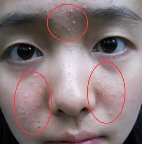脸上有螨虫的人小心 起床后有3种表现, 说明毛总算找到脸上螨虫的死