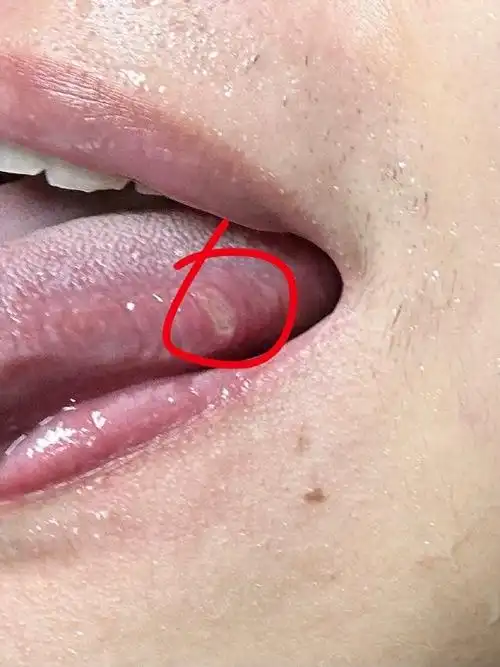 舌头旁的口腔溃疡的痛感要比嘴唇上的痛多一万倍