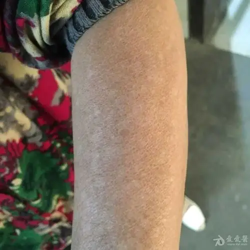 有奖猜图积分大派送181特发性点状白斑