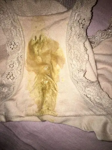 白带很黄,是因为炎症太重了吗?(下面特别痒,小便的时候有点刺痛)