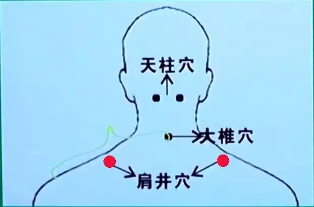肩周炎的拔罐疗法