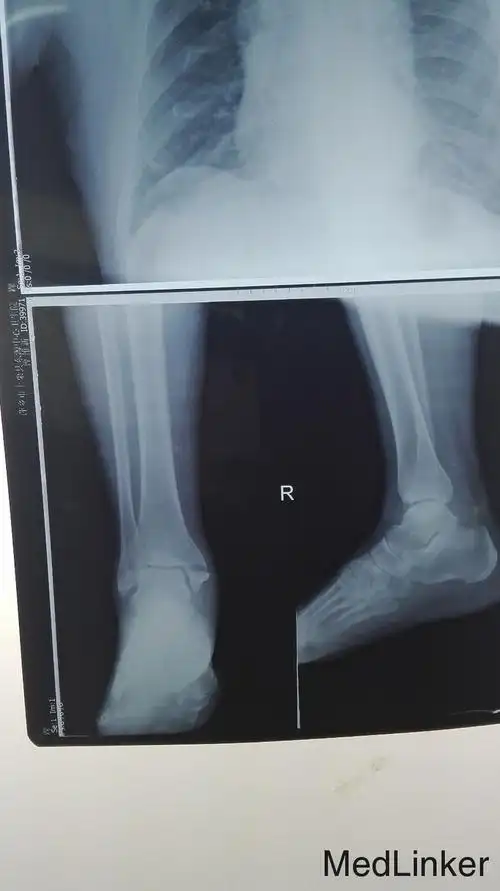 右内踝撕脱骨折