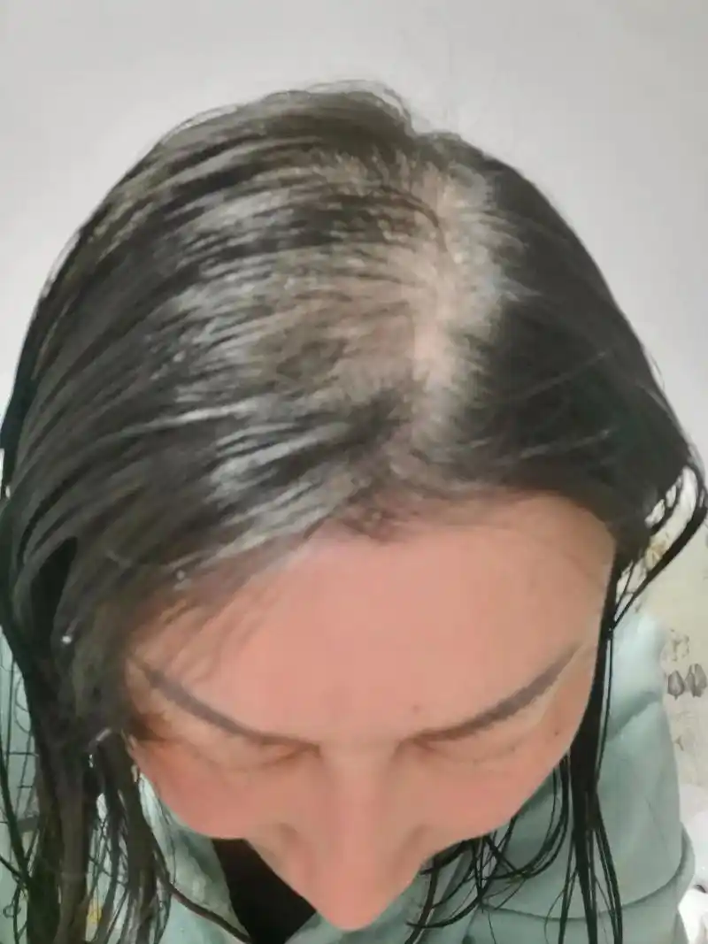 八年胃病,慢性折磨的身心俱疲,头发前面几乎秃光!早餐白面小米 - 抖音