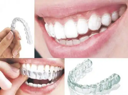 昆山成人牙齿矫正需要多少钱?