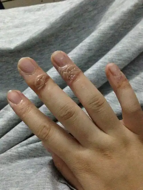 手烫伤了.现在怀孕了.刚烫伤的时候包很