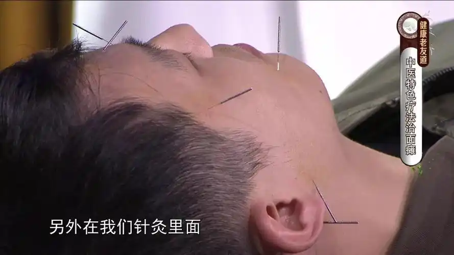 黄鳝血,生姜真的可以治疗面瘫?这些知识你要懂!