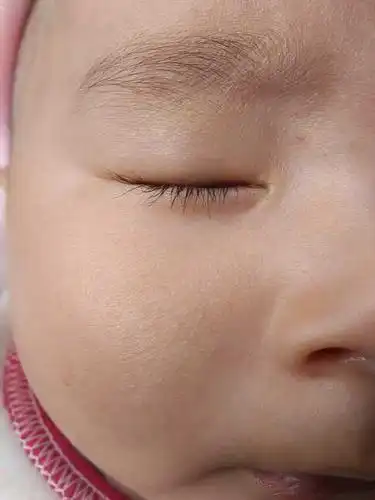 宝宝四个半月了,鼻子两边黄,半个月了还没好.