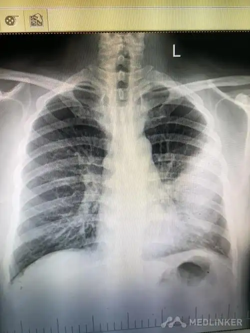 症状不典型的大叶性肺炎