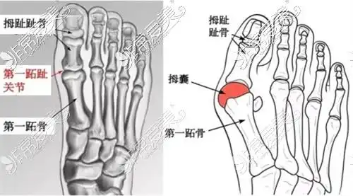 从足底骨骼结构的情况来看,大脚骨的足底骨骼是很明显的骨骼畸形,也就