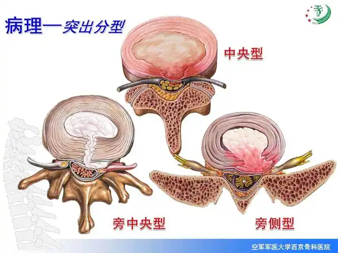 李沫教授腰椎微创手术病例_腰椎间盘突出_腰椎间盘突出治疗方式 - 好