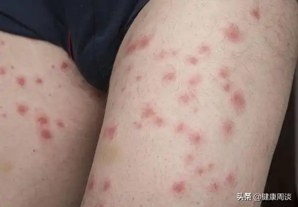 痱子湿疹区别图片及症状(痱子与湿疹有哪些不同?