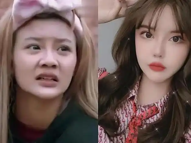 两年花400万"削骨",整容后遗症日渐严重,周楚娜:有苦说不出