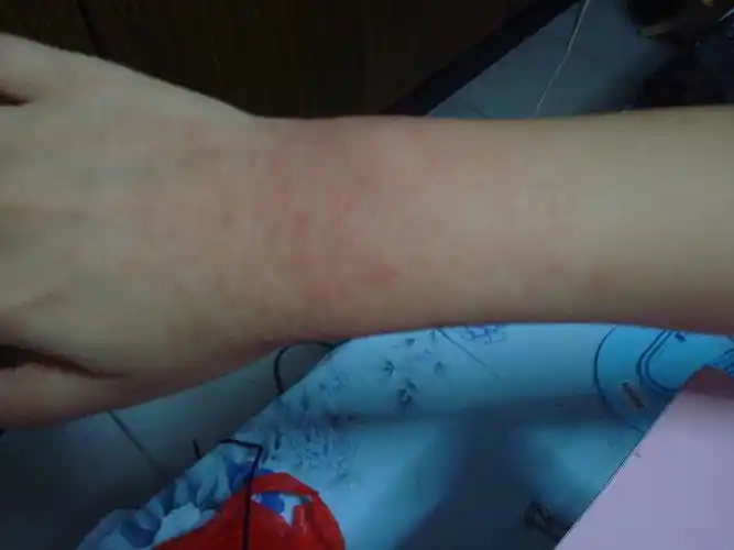 皮肤上起红包,还痒,哪个帮诊断一下