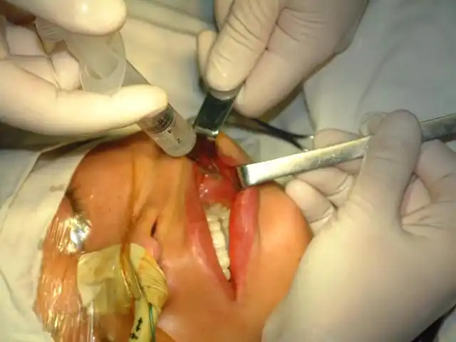 下颌角手术过程(原创)