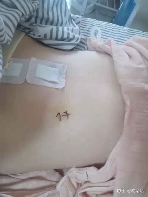 女孩子做完腹腔镜阑尾炎微创手术恢复全过程 - 知乎