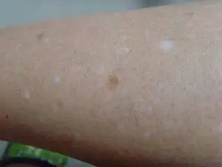 皮肤出现白斑症状是否为白癜风