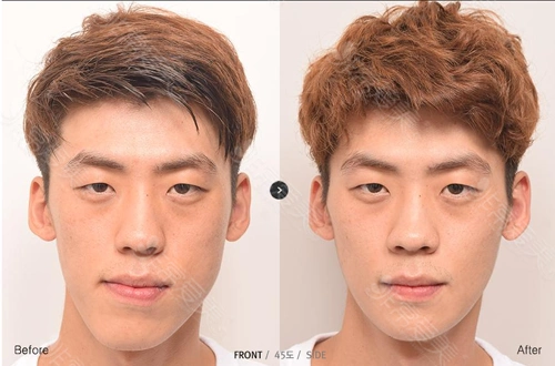 韩国男士脸部整容价格表曝光文末这几家医院许多男生去