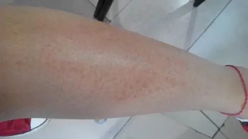 皮肤四季都是干燥,而且局部面积有像疤痕一样,很多小块,怎么办呢