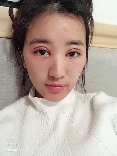 这是曹阳院长给我做双眼皮修复手术后第一天的样子,形状我很喜欢,静静